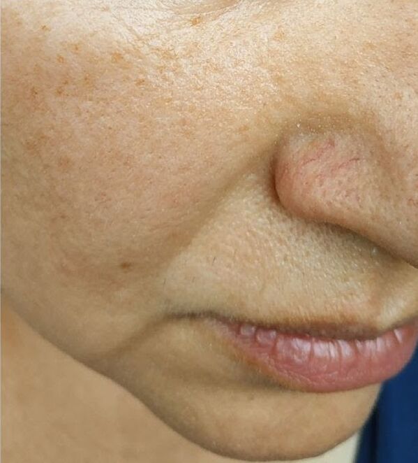 At the age of 40, nasolabial folds appeared