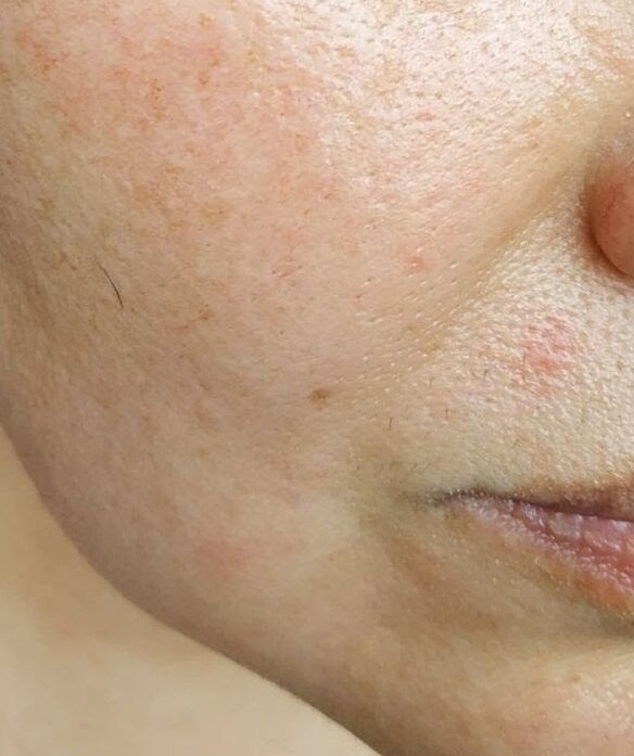 Intenkin was removed from deep nasolabial wrinkles