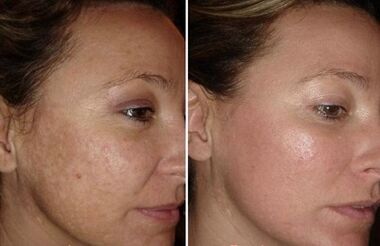 Laser facial skin rejuvenation before and after photos